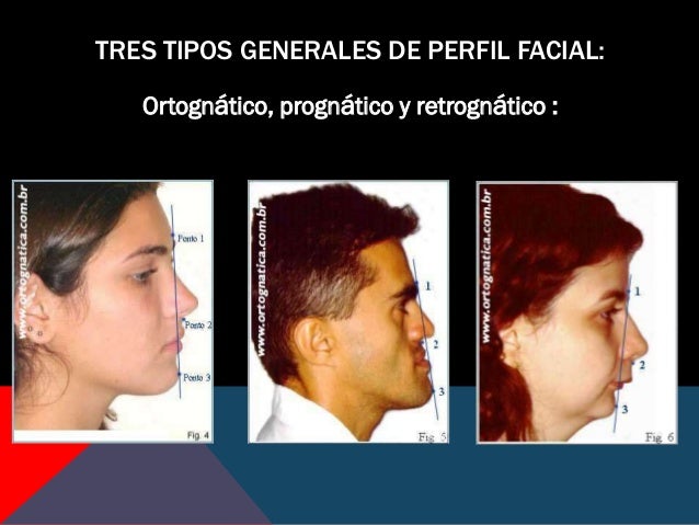 Amanda bynes fake naked Convexidad facial + pacientes clase ii div 1